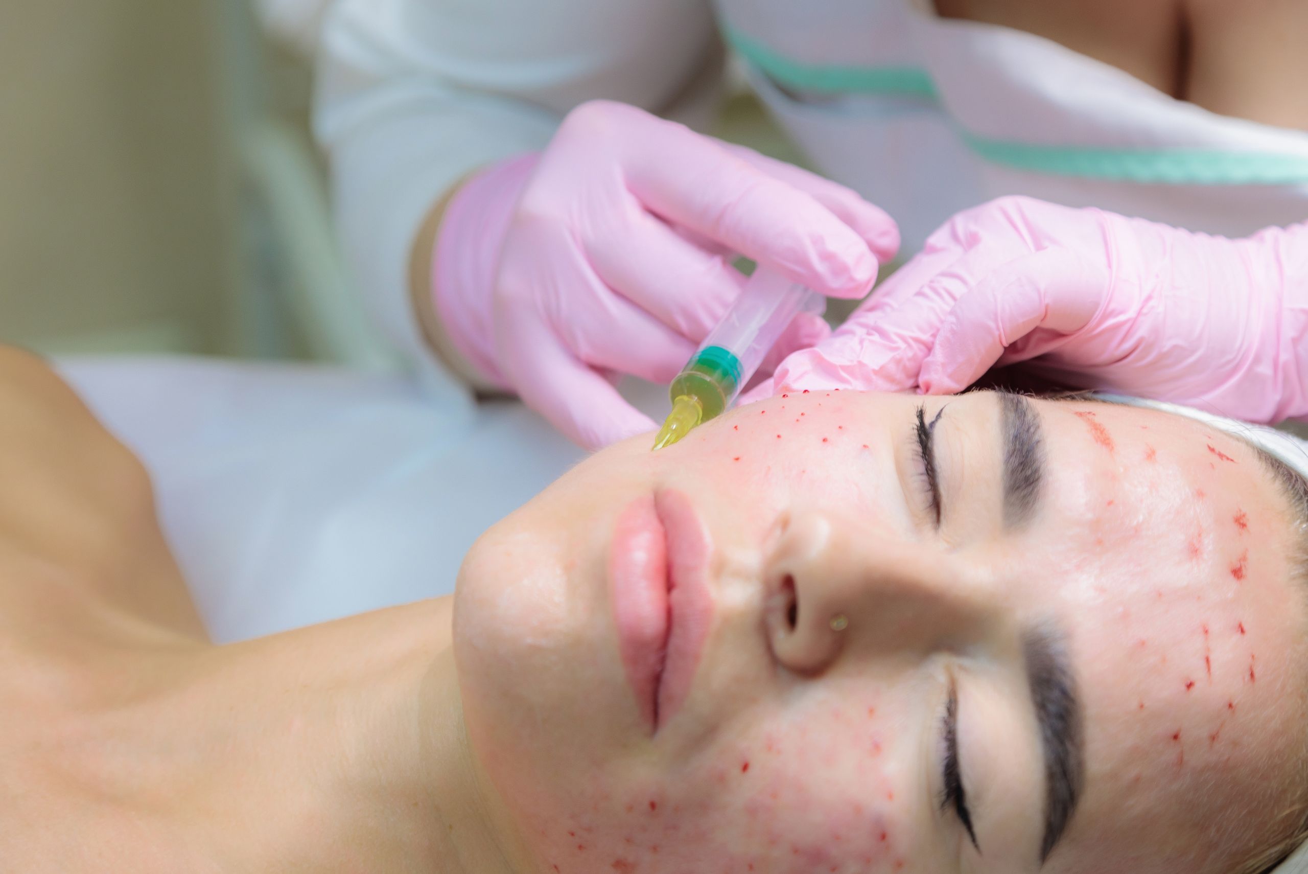Best Doctors for Acne treatment in Raipur