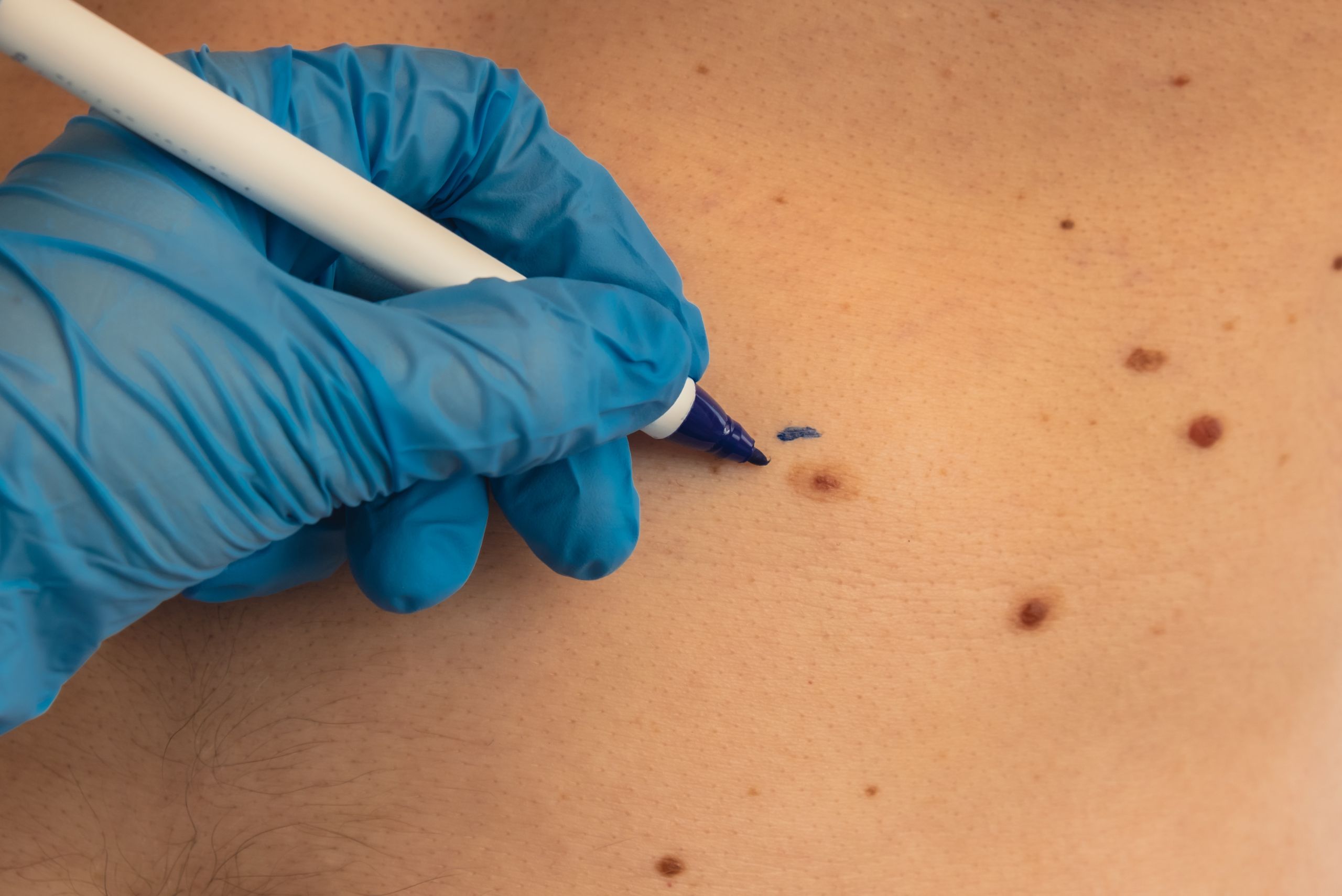 Best Doctors for Acne treatment in Raipur